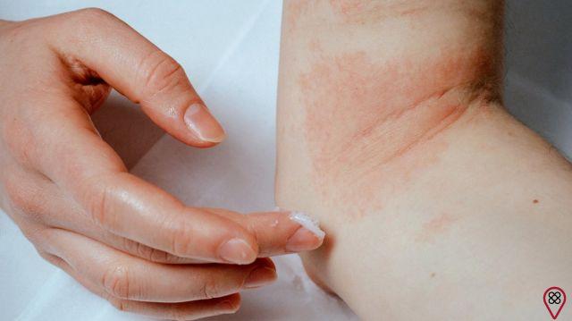 Eczema negli adulti: la cura è nel tuo comportamento